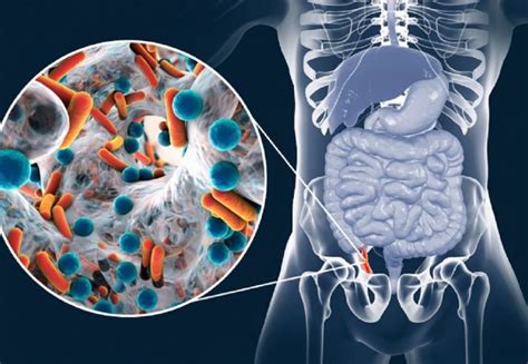 apendicita acuta|Apendicita acută: simptome, tratament, complicații